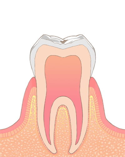 【う蝕の程度】C0→ムシ歯の初期状態