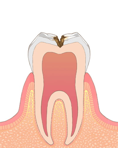 【う蝕の程度】C2→ムシ歯の後期状態（初期）