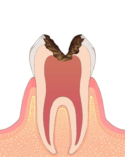【う蝕の程度】C3→ムシ歯の後期状態（後期）