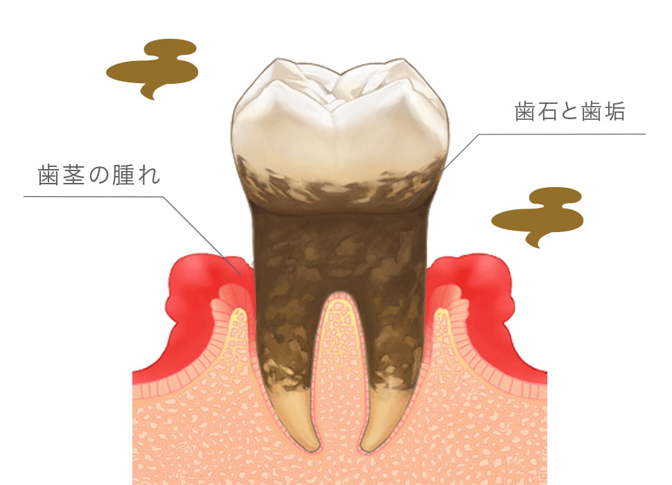 歯茎に起こる化膿性の炎症