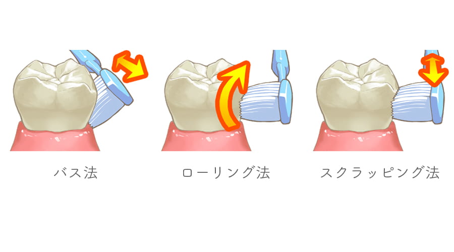 歯周病の症状の進み順