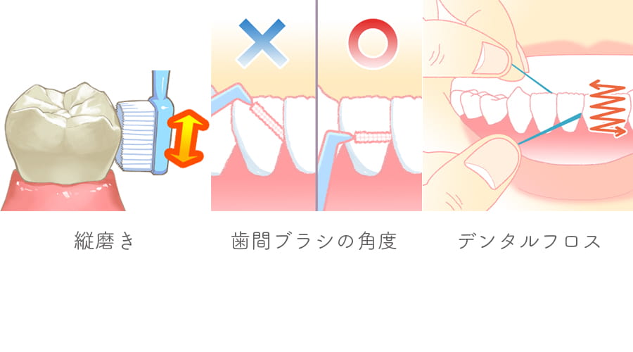 歯周病の症状の進み順