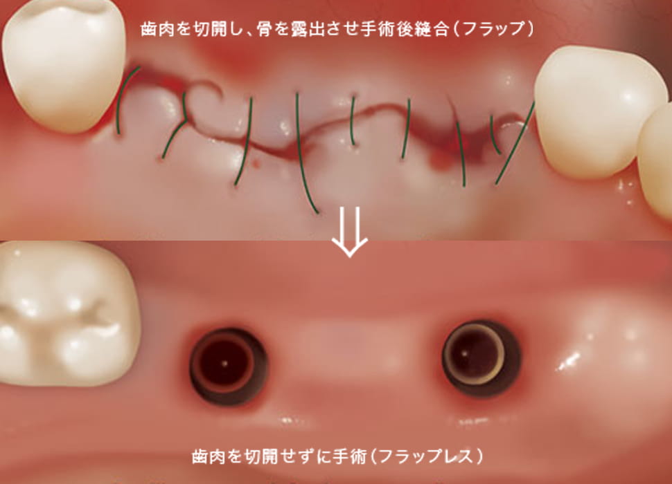 デジタルインプラントの特徴