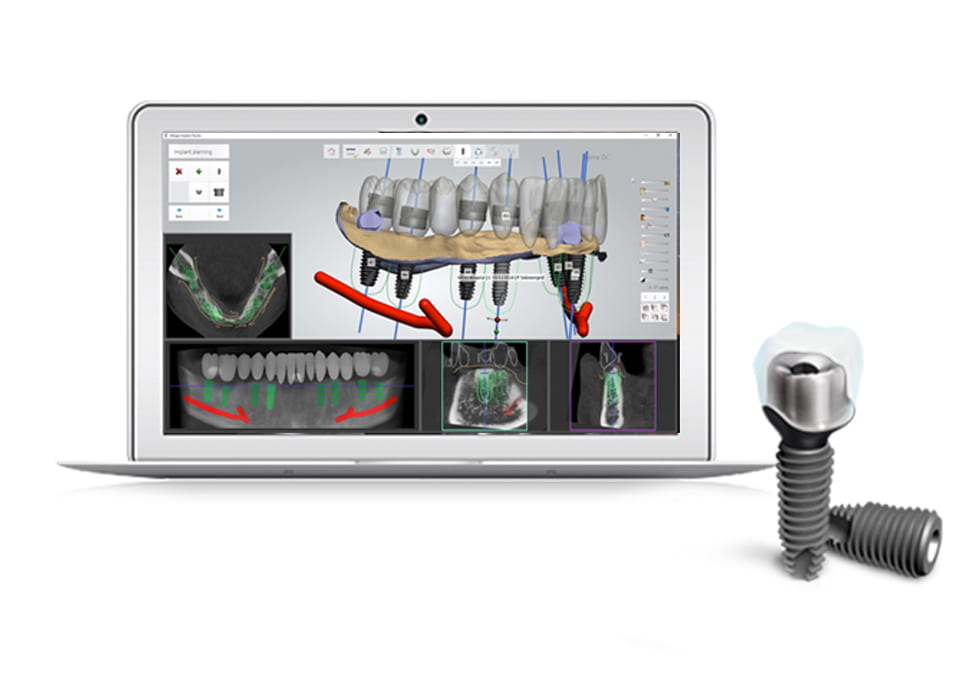 デジタルインプラント・シミュレーション
