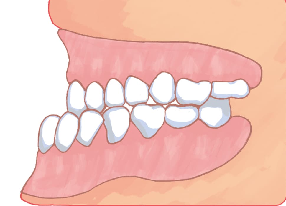 下顎前突・反対咬合
