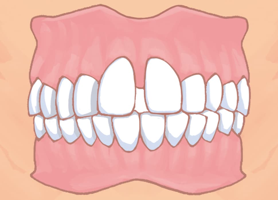 空隙歯列