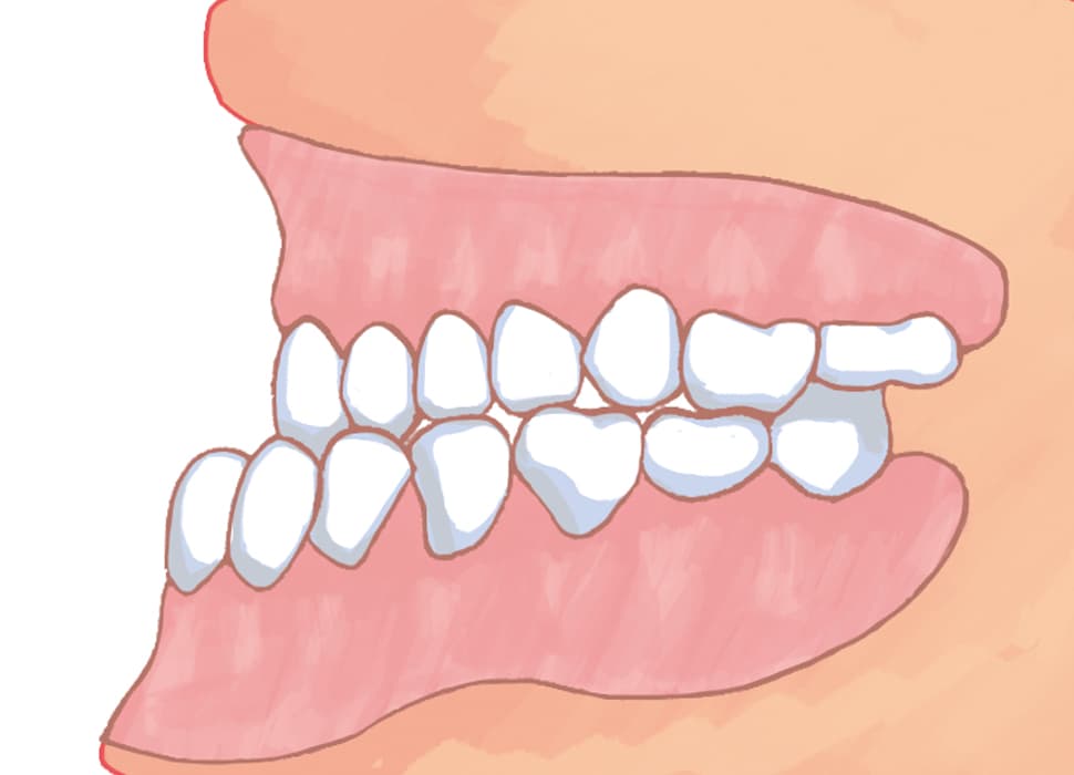 下顎前突・反対咬合