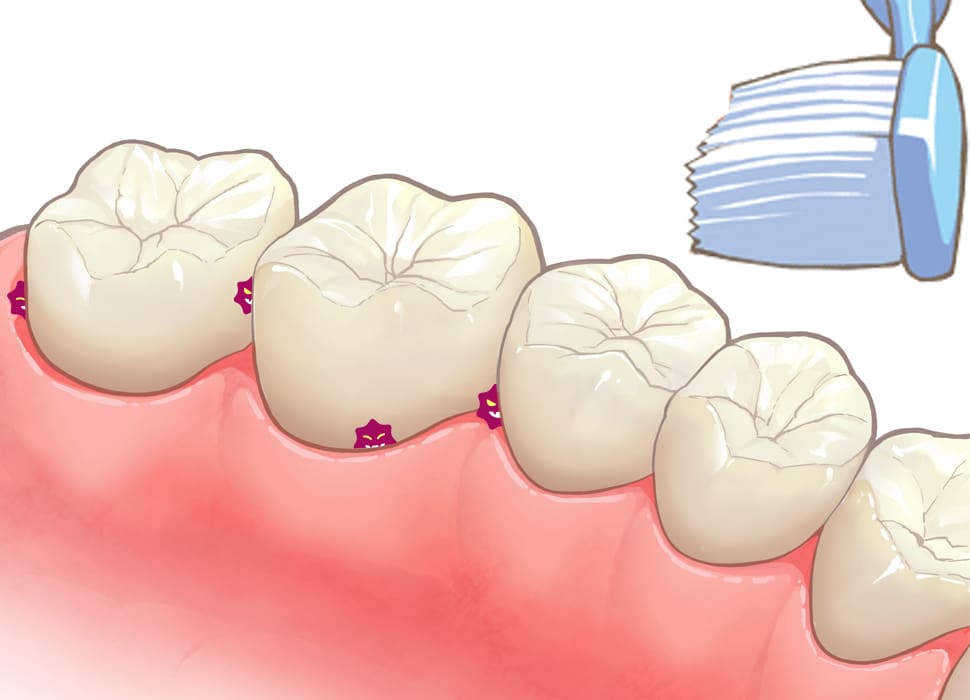 歯磨きだけでは落とせない汚れ