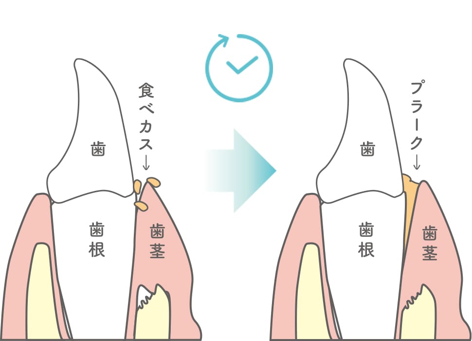 食べカスがプラークに