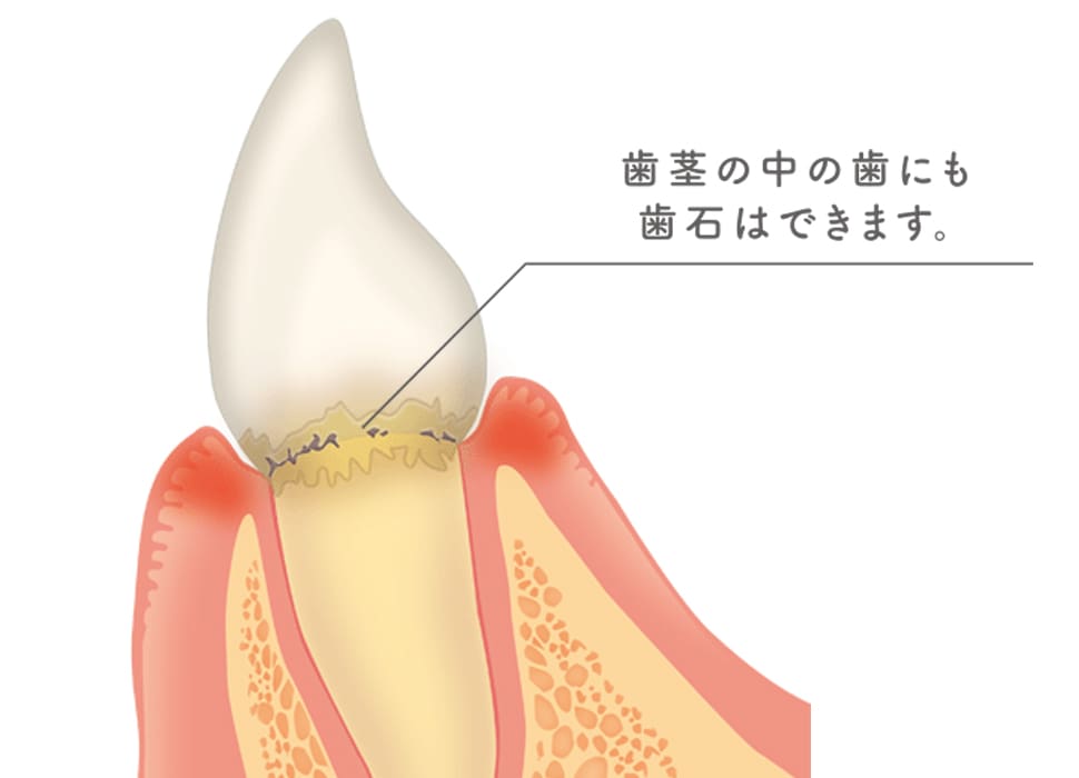 歯茎の中に歯石