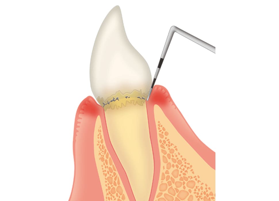 歯周ポケット検査
