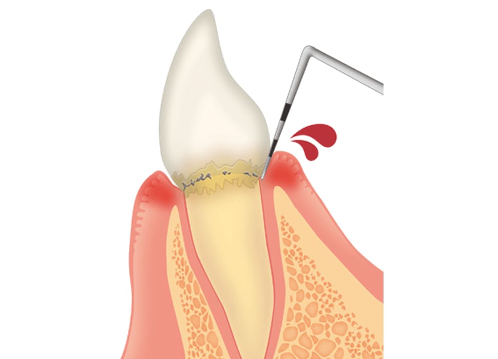 歯周ポケット検査