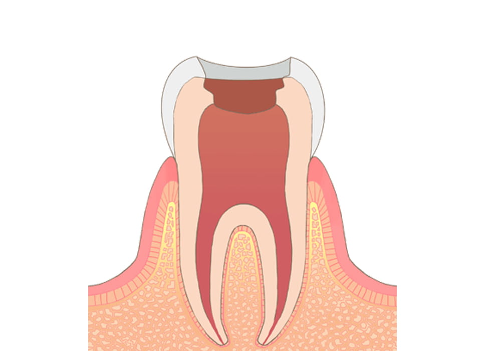 虫歯を削る