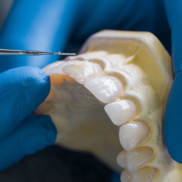 セラミック治療（補綴治療）