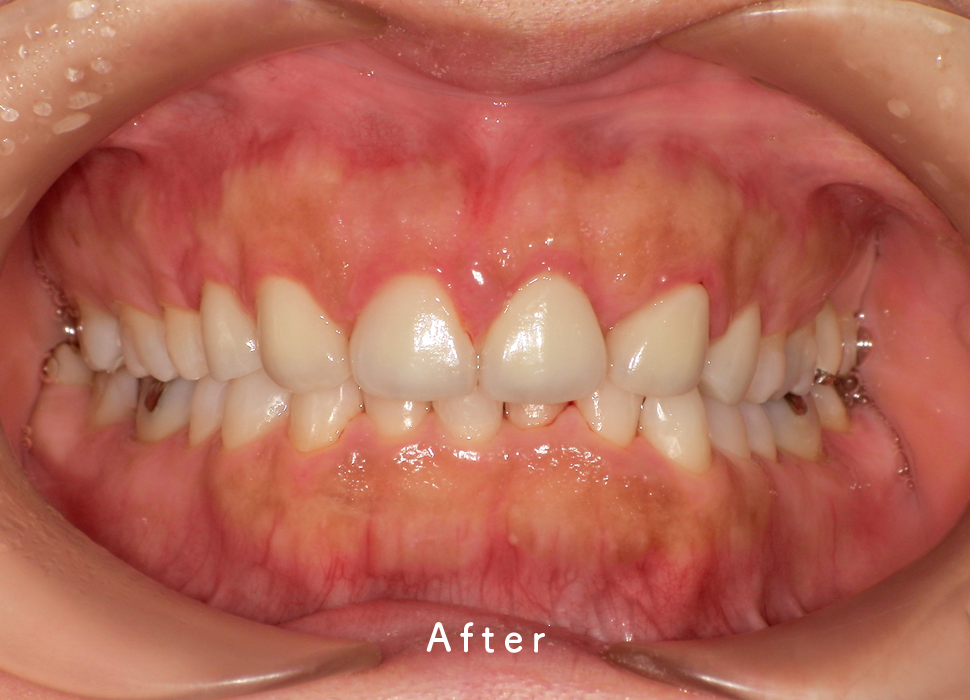 入れ歯・補綴の症例