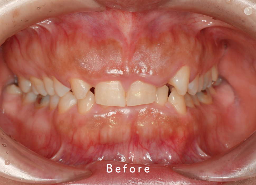 入れ歯・補綴の症例