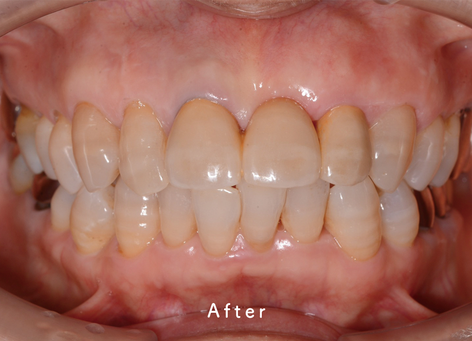 入れ歯・補綴の症例