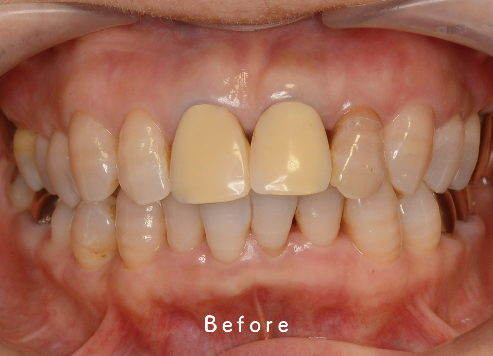入れ歯・補綴の症例