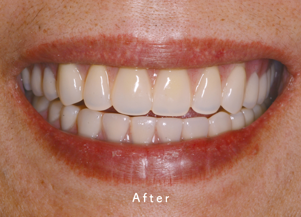 入れ歯・補綴の症例