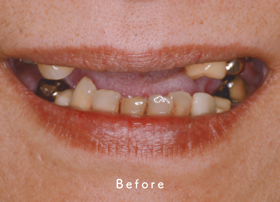 入れ歯・補綴の症例