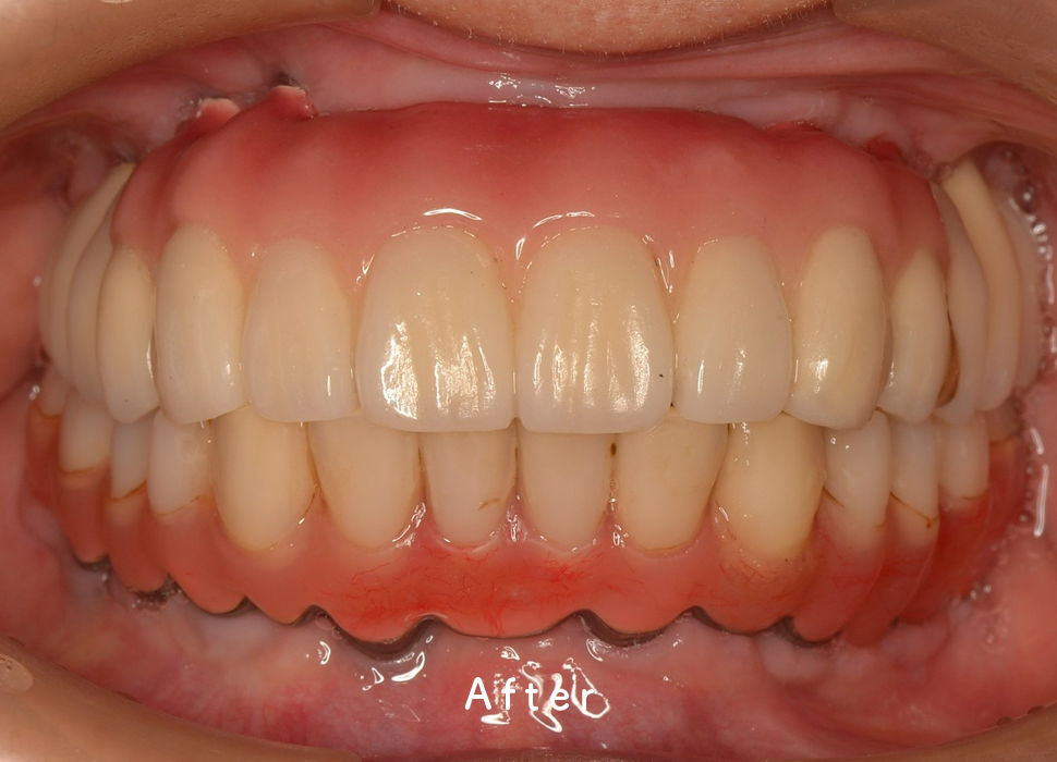 入れ歯・補綴の症例