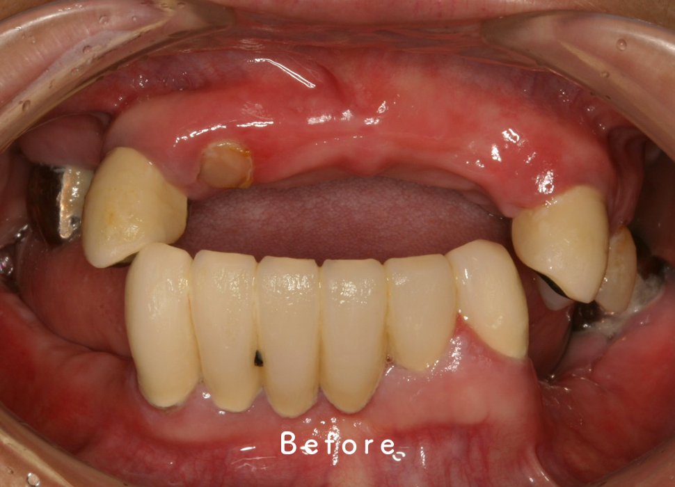 入れ歯・補綴の症例