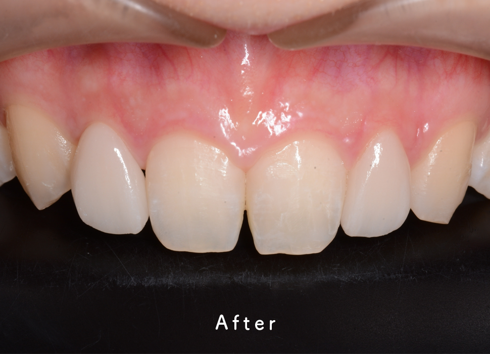 入れ歯・補綴の症例