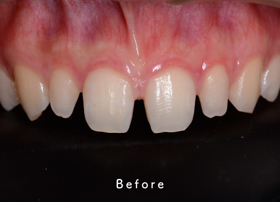 入れ歯・補綴の症例