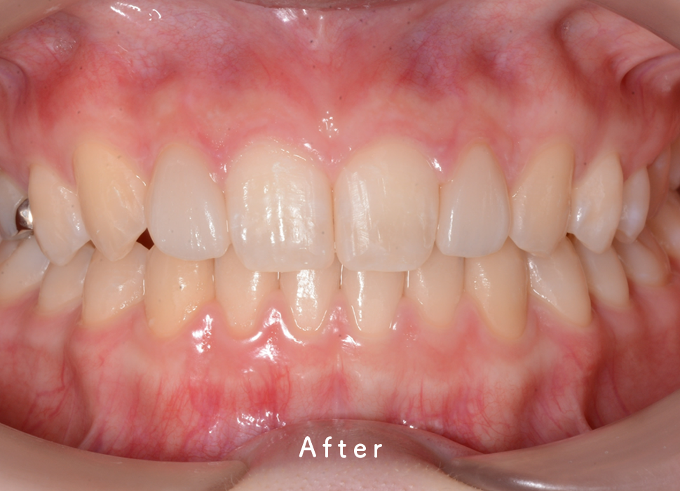 入れ歯・補綴の症例