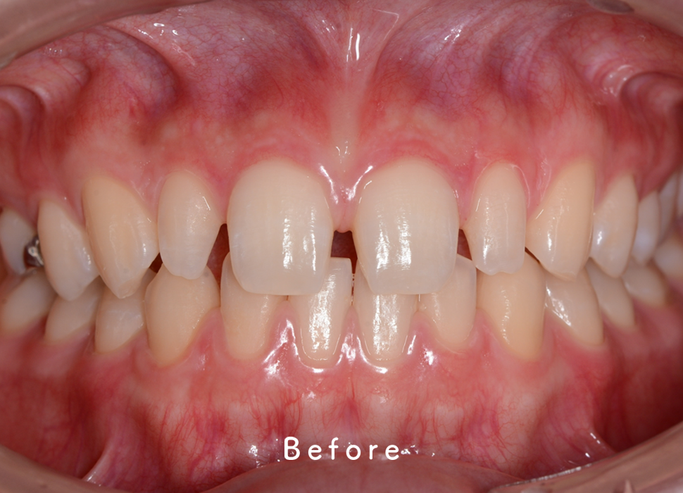 入れ歯・補綴の症例