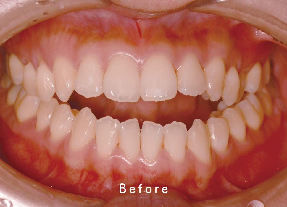 インビザライン矯正の症例