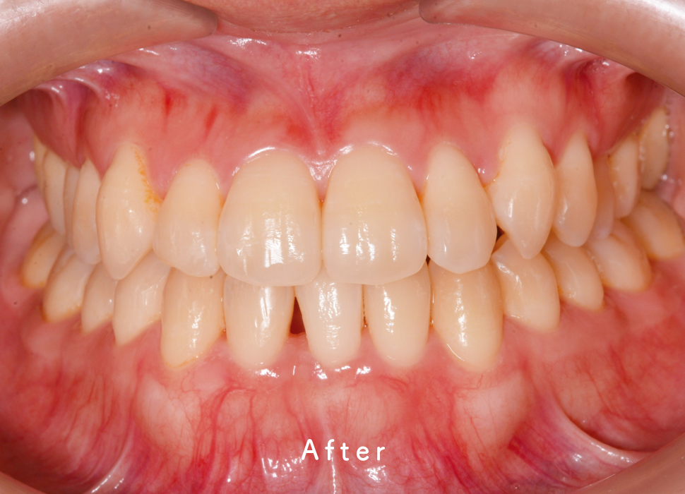 インビザライン矯正の症例