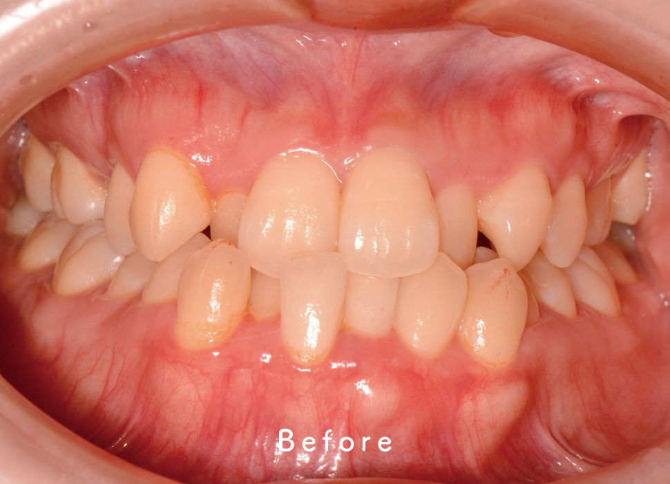 インビザライン矯正の症例