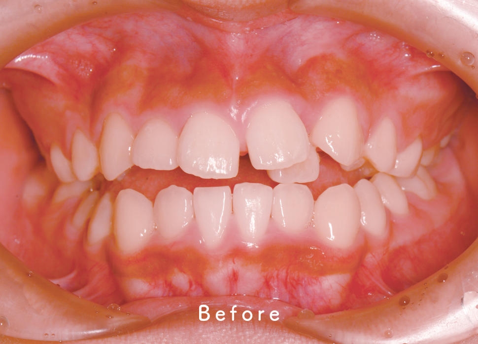 インビザライン矯正の症例